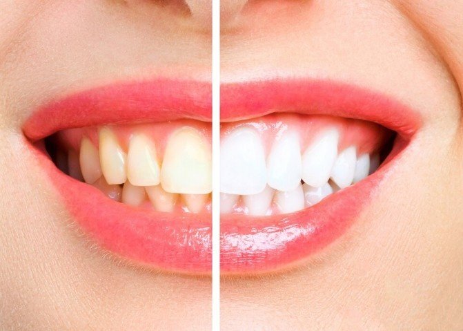 Best Teeth Whitening Treatment in Ghaziabad