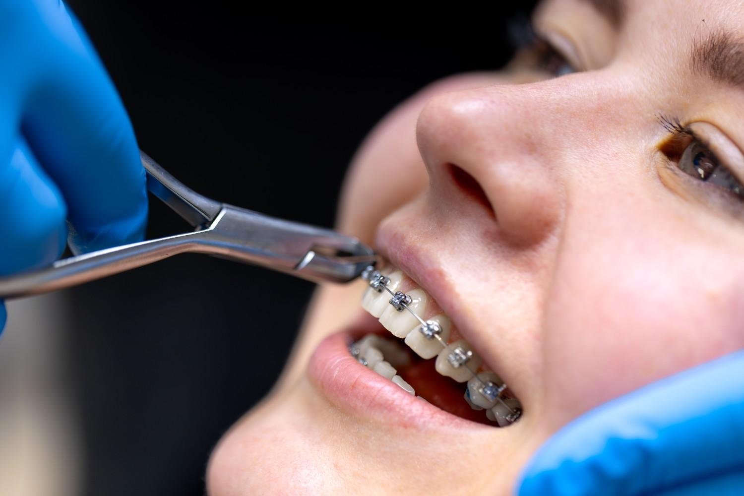 Best Teeth Bonding Centre in Ghaziabad