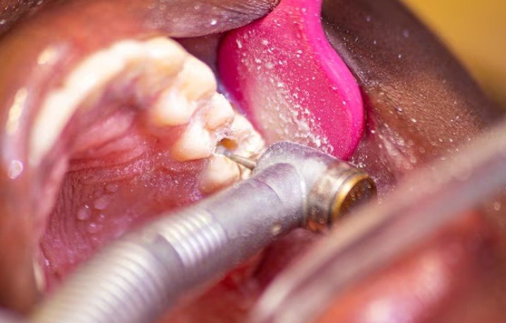Best Dental Fillings & Sealants Service in Ghaziabad
