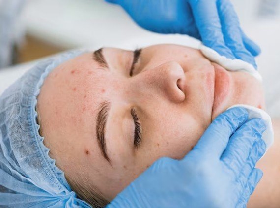 Dermatologist performing facial care procedure for a woman with acne and dark spots at the Best Pigmentation Treatment in Shastri Nagar